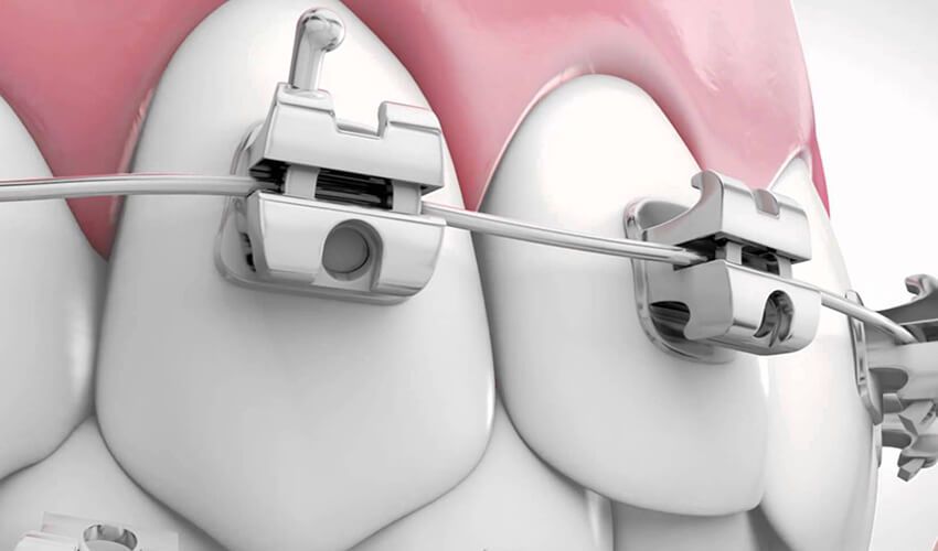 bung mắc cài khi niềng